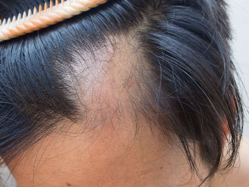 Alopecia New York, Medical Hair Loss New York