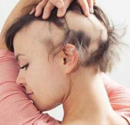 Permanent alopecia in patients with breast cancer after taxane chemotherapy  and adjuvant hormonal therapy Clinicopathologic findings in a cohort of 10  patients  ScienceDirect